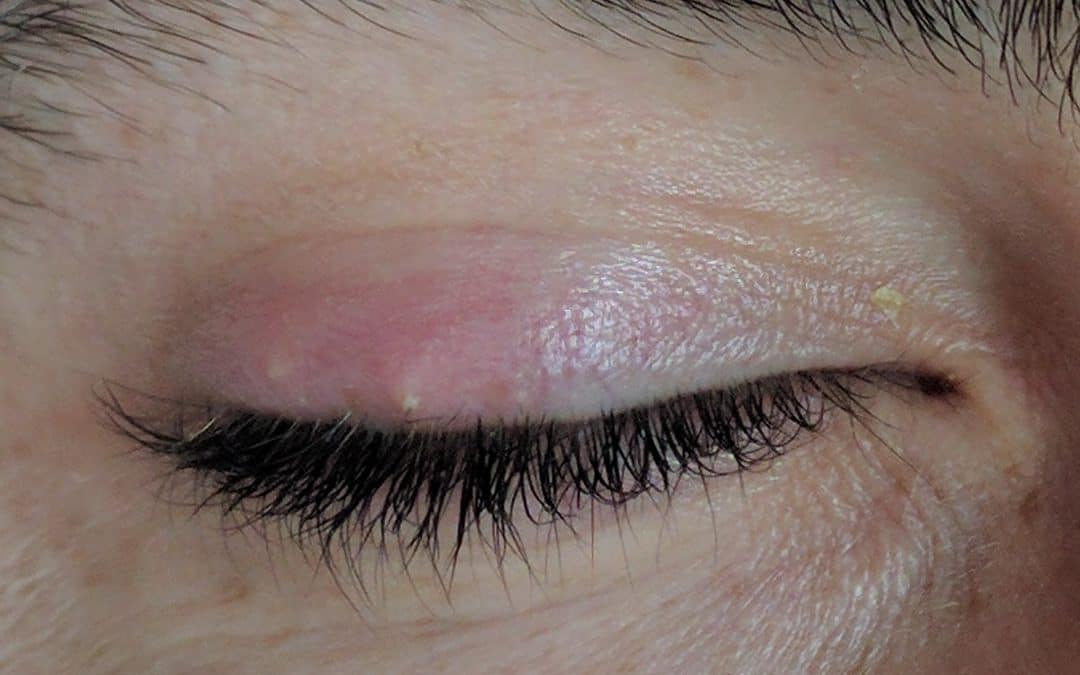 What Would Cause Recurrent Styes on the Eyelid