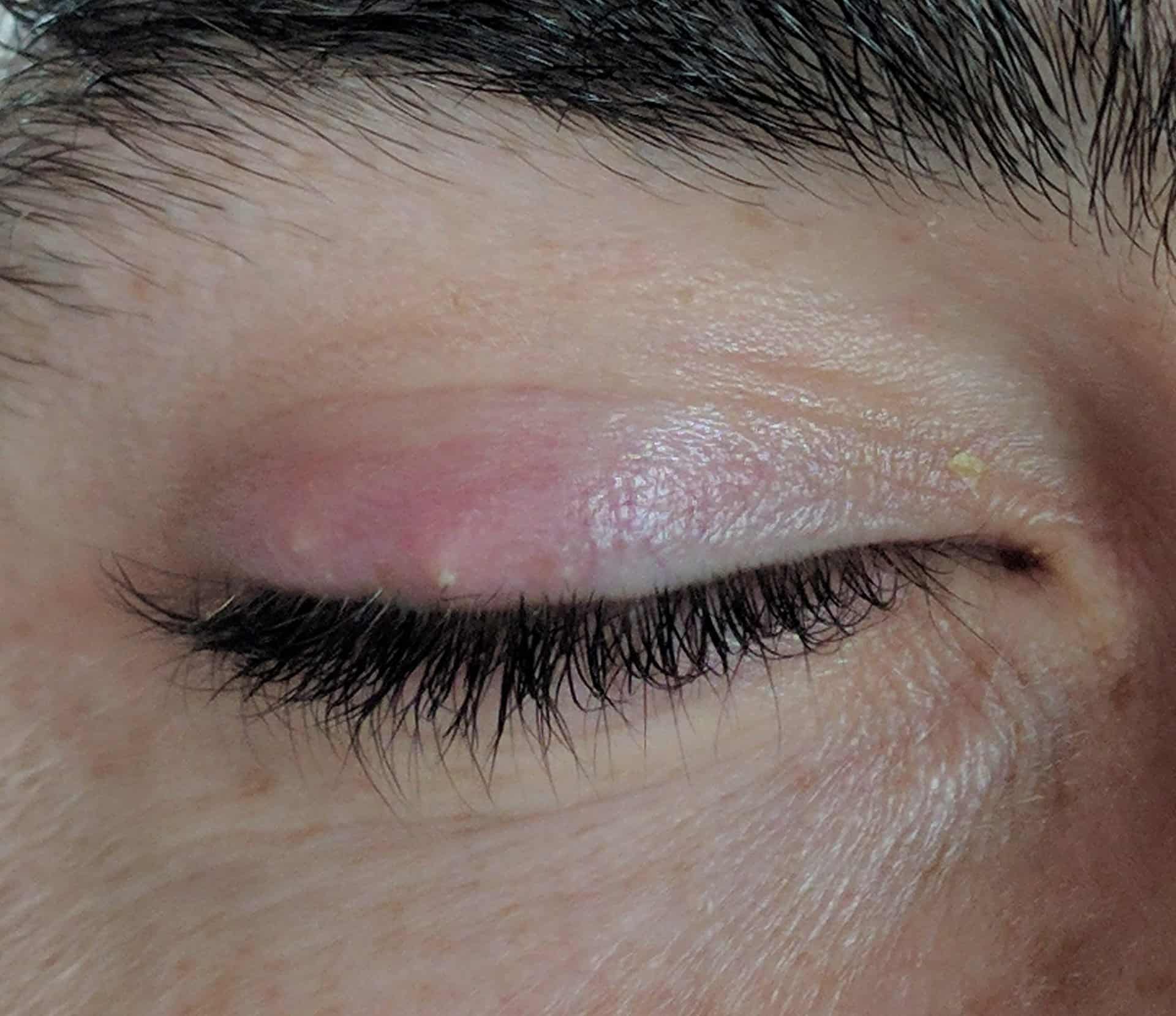 What Would Cause Recurrent Styes on the Eyelid