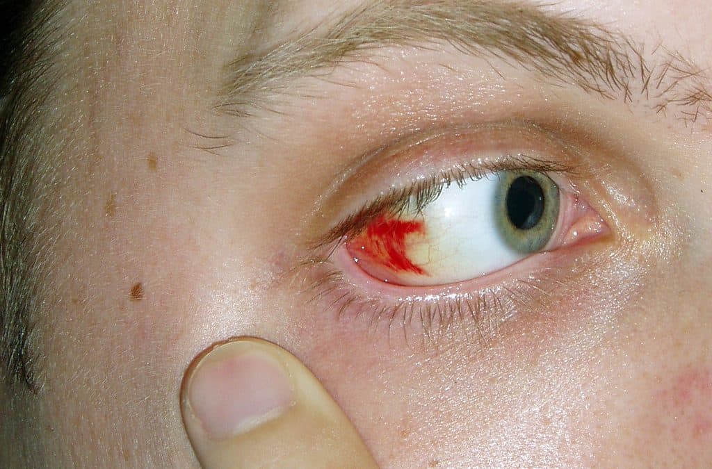 What Can Cause Blood in the Eye After Eye Surgery?