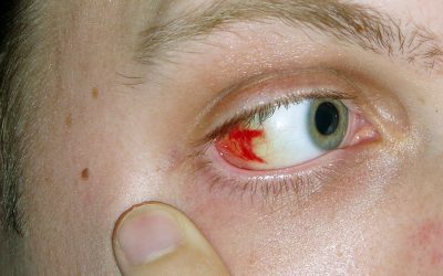 What Can Cause Blood in the Eye After Eye Surgery?