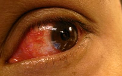 What Is the Difference Between Iritis and Scleritis?